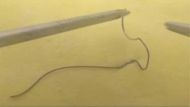 An image of the "Suturing Tips & Tricks: Managing Suture Tag Length with Russell Pruitt, MD" video.