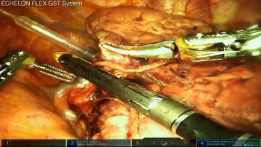 Robotic Right Upper Lobectomy with Mark Dylewski, MD