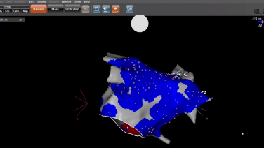 An image from the "Atypical Atrial Flutter using the CONFIDENSE® Module & PENTARAY® Nav Eco Catheter with Daniel Melby, MD" video on the JnJInstitute.com website.