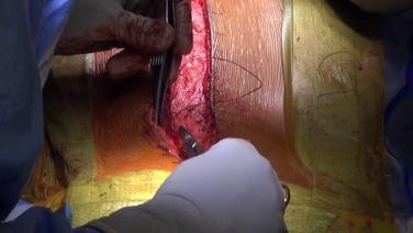 An image of the "Innovative Wound Closure Technique in Spinal Fusion Surgery with Suken A. Shah, MD" video.