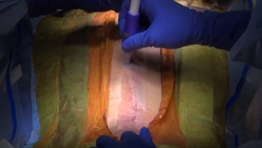 An image from the "DERMABOND® PRINEO® Skin Closure System (22cm) in Spine Deformity Surgery" video on the JnJInstitute.com website.