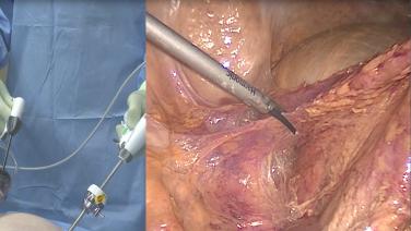 Laparoscopic Right Colectomy: Step 2 Mobilize TI, Right Colon with David Longcope, MD
