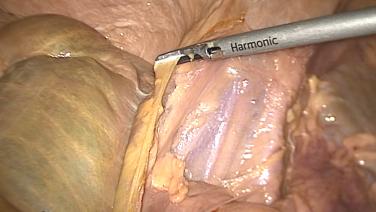 An image of the "Laparoscopic Left Colectomy & LAR - Step 3: Mobilize Left Colon, Recto-sigmoid with David Longcope, MD" video.