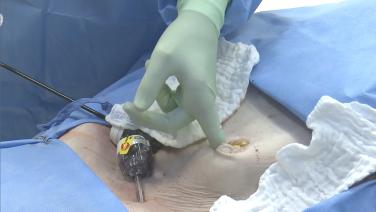 An image of the "Laparoscopic Left Colectomy LAR - Step 6c: Exteriorize, Resect, Anvil (Triple Staple) with David Longcope, MD" video.