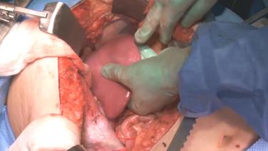 An image of the "Partial Non-Anatomic Liver Resection with Steven Trocha, MD" video.