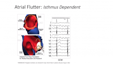 An image from the "Typical Atrial Flutter with Melvin Scheinman, MD" video on JnJInstitute.com website.