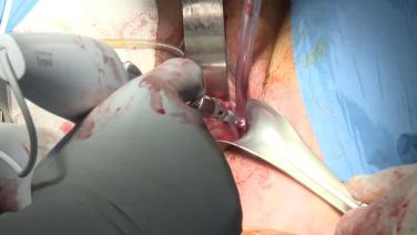 An image of the "Vaginal Hysterectomy with Ira Stanley Frye, MD" video.
