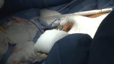 An image of the "Total Abdominal Hysterectomy with Ira Stanley Frye, MD" video.