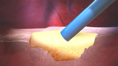 An image of the "SURGIFLO Hemostatic Matrix - Mechanism of Action" video.