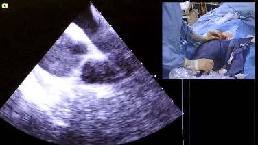 An image of the "Intracardiac Echo Views During the AF Procedure with Brett Gidney, MD" video on the JnJInstitute.com website.