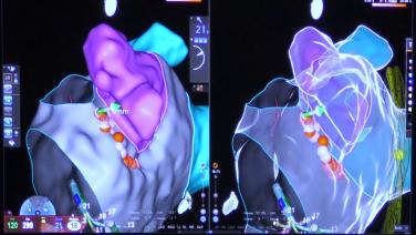 An image from the "Catheter Manipulation and Clinical Considerations During the AF Procedure with Brett Gidney, MD" video on the JnJInstitute.com website.