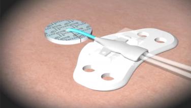 An image displaying the appropriate application of the BIOPATCH.