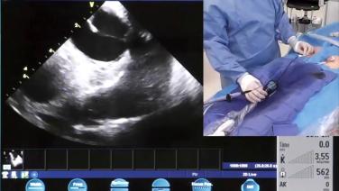 An image of the "In the EP Lab - ICE & Mapping During the PVC Case with Andrew Brenyo, MD" video on the JnJInstitute.com website.