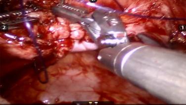 An image of the "STRATAFIX™ Spiral PDS™ Plus Knotless Tissue Control Device - Robotic Total Laparoscopic Hysterectomy to Close the Vaginal Cuff " video.
