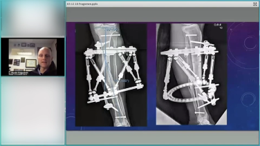 An image of the "Maximizing Post-Traumatic Deformity Correction" video on the JnJInstitute.com website.