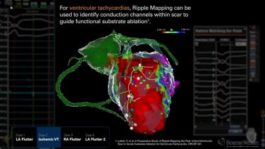 An image of the "The Value of Ripple Mapping" video.