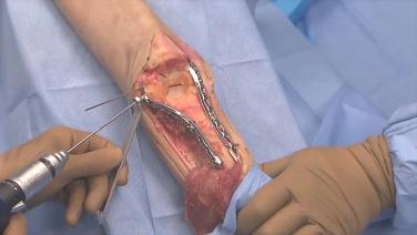 An image of the "VA LCP® Elbow Plating System - Distal Humerus Perpendicular Plating Video".