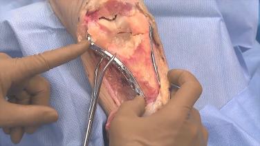 An image of the "VA LCP® Elbow Plating System - Distal Humerus Parallel Plating Technique Video".