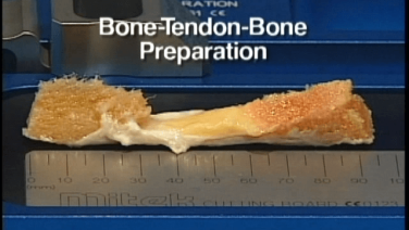 Thumbnail image of Bone-Tendon-Bone Graft Preparation