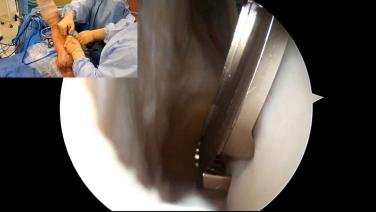 An image from the "Rotator Cuff Repair Using HEALIX Anchors with Anthony Scillia, MD" video on the JnJInstitute.com website.