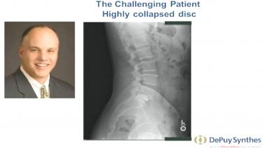 An image of Dr. John Hall discussing a "challenging patient" with a highly collapsed disc.