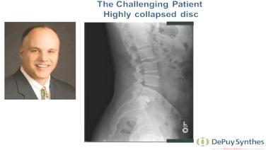 An image of Dr. John Hall discussing a "challenging patient" with a highly collapsed disc.
