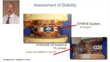 image of "Stand Alone ALIF - Benefits, Biomechanics & Outcomes with Christopher Cain, MD"