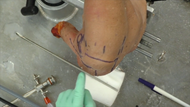 An image from the "Standard Portals for Shoulder Arthroscopy with Stephanie Muh, MD" video on the JnJInstitute.com website.