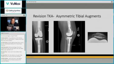 Image of the ATTUNE® Knee System: Primary Data Update and Revision System First Cases video.