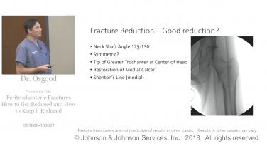 An image of the "Peritrochanteric Hip Fractures: How to Get Reduced & Keep Reduced with Greg Osgood, MD" video on the JnJInstitute.com website.