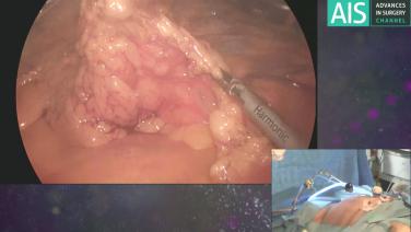 An image of the "Revision Bariatric Surgery - Sleeve to Duodenal Switch with Michel Gagne, MD, FRCSC, FACS" video on the JnJInstitute.com website.