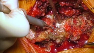 An image from the "Screw Site Preparation & Rod Placement with Victor Chang, MD" video on the JnJInstitute.com website.