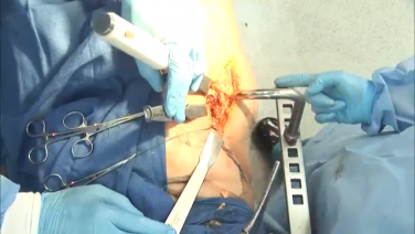 Surgical Tips & Pearls: Broaching the Fractured Femur in Anterior Approach with Tania Ferguson, MD