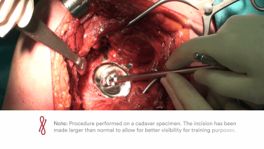 BiMentum Removal of Anchoring Pegs thumbnail