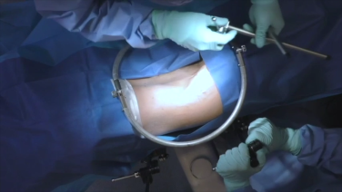 An image from the "Anterior to the Psoas Surgical Demonstration with Joshua Herzog, MD" video on the JnJInstitute.com website.