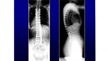 Image from: "PSO and Other Osteotomies" on the jnjinstitute.com website