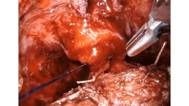 An image from the "Robotic Prostatectomy Procedure Using STRATAFIX™ Spiral PDS™ Plus with Michael Stifelman, MD" video on the JnJInstitute.com website.