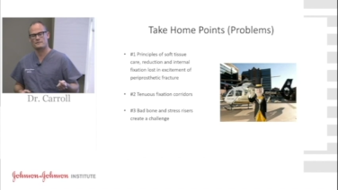 An image of the "Periprosthetic Femur Fractures: Vancouver B with Eben Carroll, MD" video.
