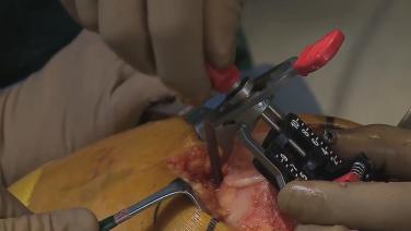 Image from the "Live ATTUNE® Knee System TKA Surgical Procedure with Dr. Robert Gorab" video.