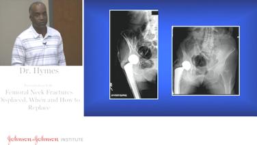 image of Displaced Femoral Neck Fractures - When & How to Replace with Robert Hymes, MD video on jnjinstitute.com