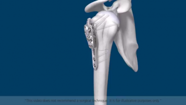 An image of the "Proximal Humerus Solutions - System Overview Animation" video on the JnJInstitute.com website.
