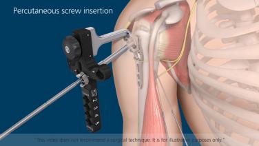 An image of the "Proximal Humerus Solutions - Percutaneous Aiming System" video on the JnJInstitute.com website.