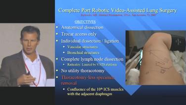 An image displaying complete port robotic video-assisted lung surgery.