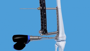 An image from the "4.5 MM VA LCP™ Curved Condylar Plate Distal Femur Fracture Plating Guide" video on the JnJInstitute.com website.