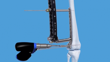 4.5 MM VA LCP™ Curved Condylar Plate Distal Femur Fracture Plating Guide