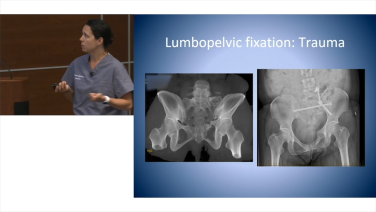 image of "Lumbopelvic Fixation & Iliac Crest Bone Grafting with Lauren Matteini, MD" video on jnjinstitute.com