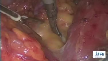 An Image From "EMEA Pelvic Lymphadenectomy"