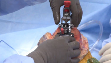 Image from the "Intuition™ Instruments Femoral Sizing Instructional Video with Douglas Dennis, MD & Brian Haas, MD " video.