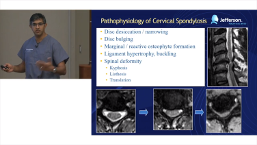 an image of the "Cervical Spine Anatomy for Decompression with Srinivas Prasad, MD" video on the JnJInstitute.com website.