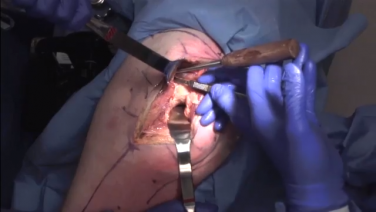 An image of the "Primary Posterior Approach: Incision & Exposure with James Germano, MD" video on the JnJInstitute.com website.